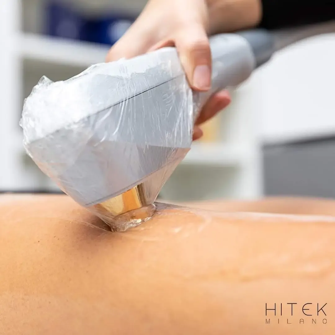 Foto del trattamento Epilazione definitiva con laser Hifiber